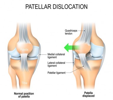 Knieschijf instabiliteit / patellaluxatie - Acute - Knie - Orthopedie Herentals